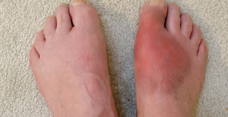 a_pair_of_feet_with_severe_red_swelling
