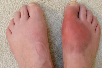 a_pair_of_feet_with_severe_red_swelling